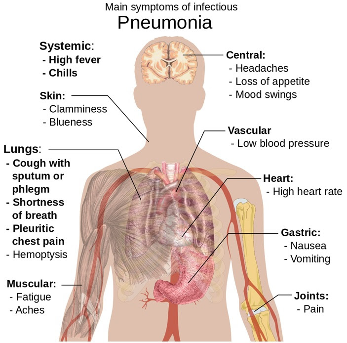 Pneumonia: Overview, Types, Causes, Risk factors, Signs And Symptoms, Prevention And Complications