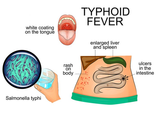 Typhoid Fever: Overview, Causes, Signs And Symptoms, Treatment and Prevention